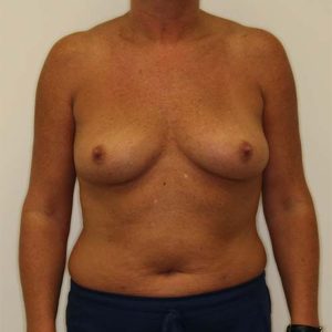 Before Breast Augmentation Female Patient Front Angle View Case 984