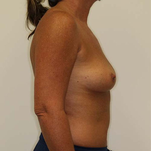 Before Breast Augmentation Female Patient R Side Angle View Case 984