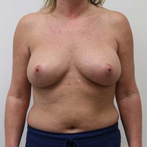 After Breast Augmentation Female Patient Front Angle View Case 984