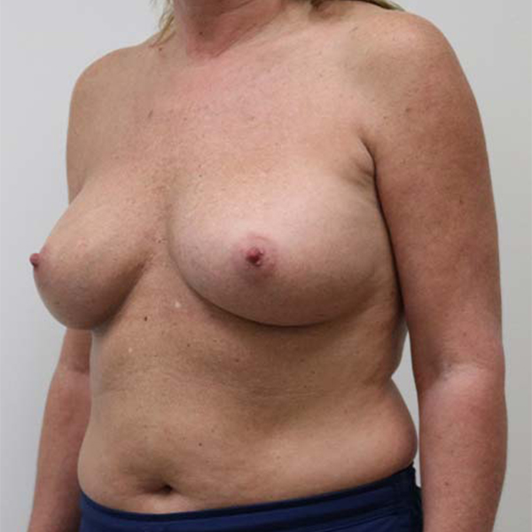 After Breast Augmentation Female Patient L Diagonal Angle View Case 984