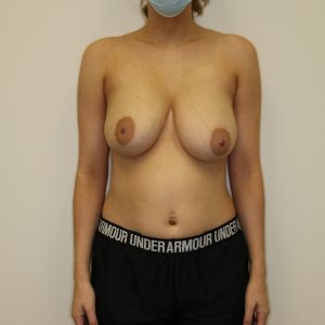 before breast lift with implants front view case 2610