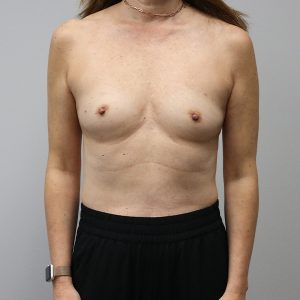 before breast reconstruction front view of female patient case 3249