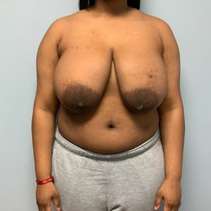before breast reduction front view of female patient case 3082