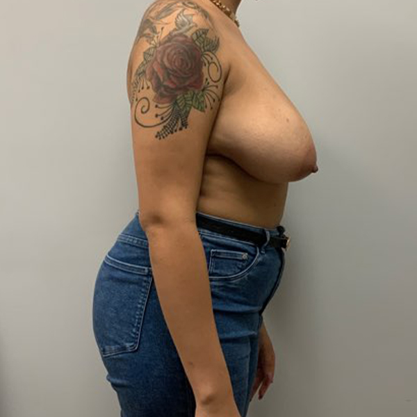 before breast reduction right view of female patient case 3093
