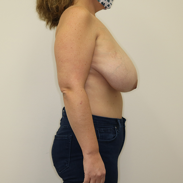 before breast reduction right view of female patient case 3104