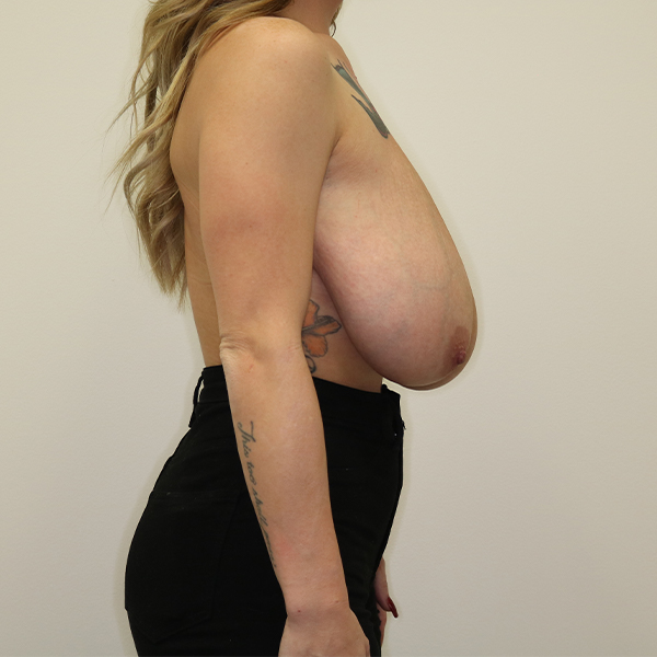 before breast reduction right view of female patient case 3137