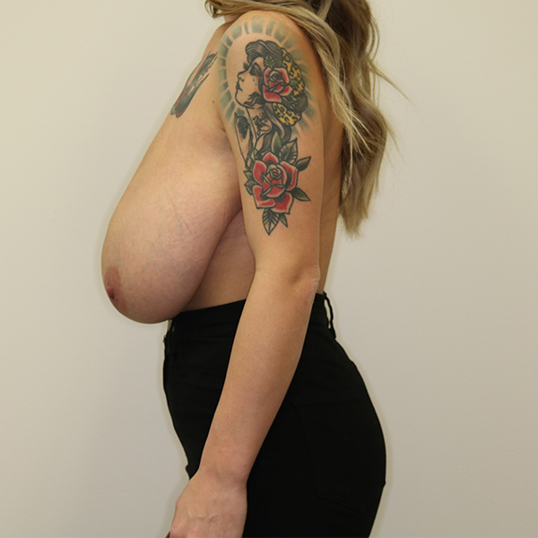 before breast reduction left view of female patient case 3137