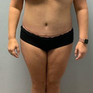 after tummy tuck front view of female patient case 2632
